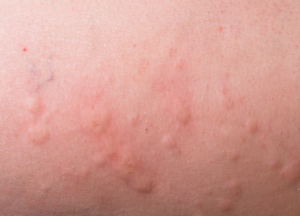 urticaria