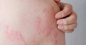 urticaria