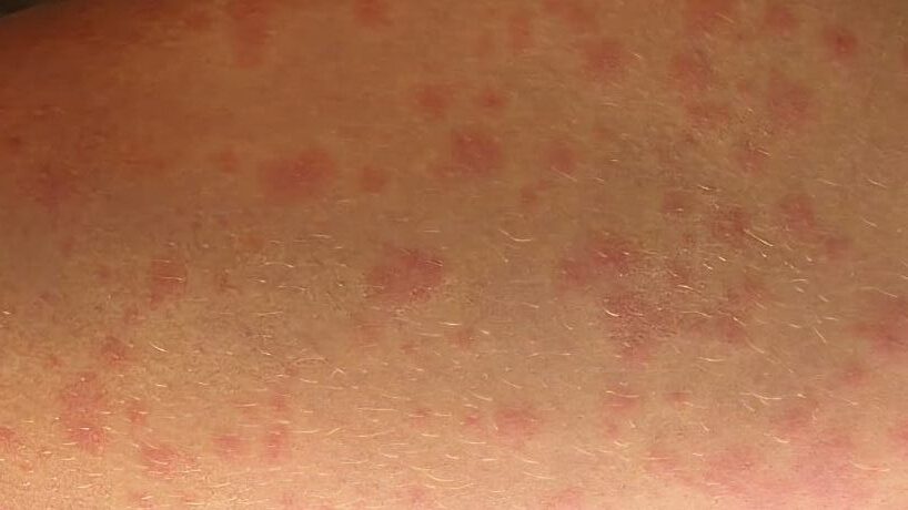 urticaria